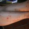 Rachmans collection of mosquito bites @ Barbados